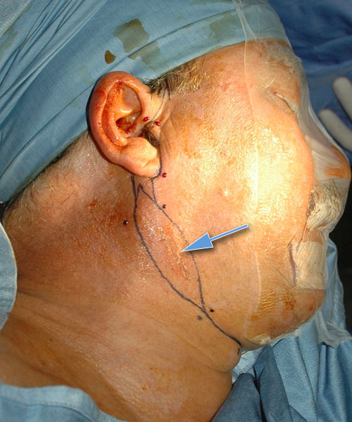 Tumore Maligno Parotide - Carcinoma Mucoepidermoide