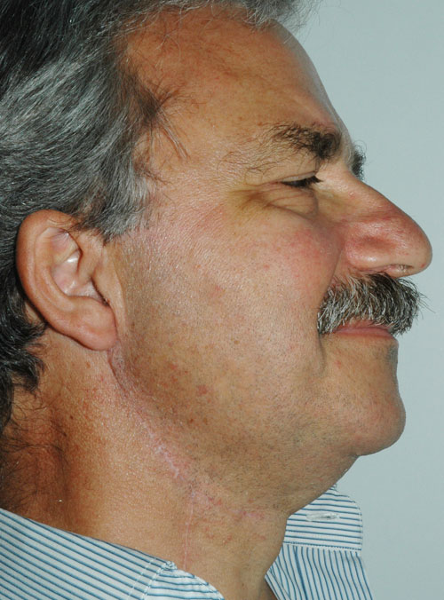 Tumore Maligno Parotide - Carcinoma Mucoepidermoide