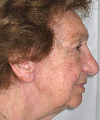 Tumore Maligno Parotide - Carcinoma AdenoidoCistico